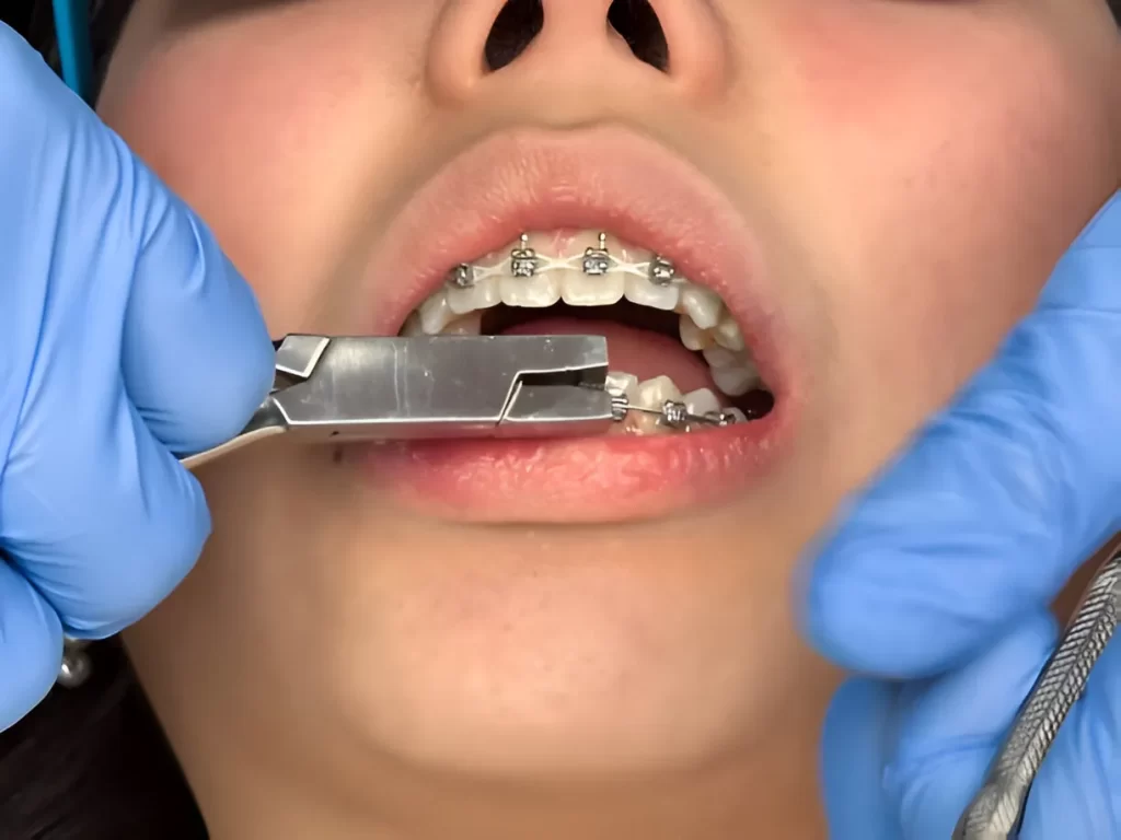 How to Choose a Safe Dental Clinic and Avoid Fake Braces