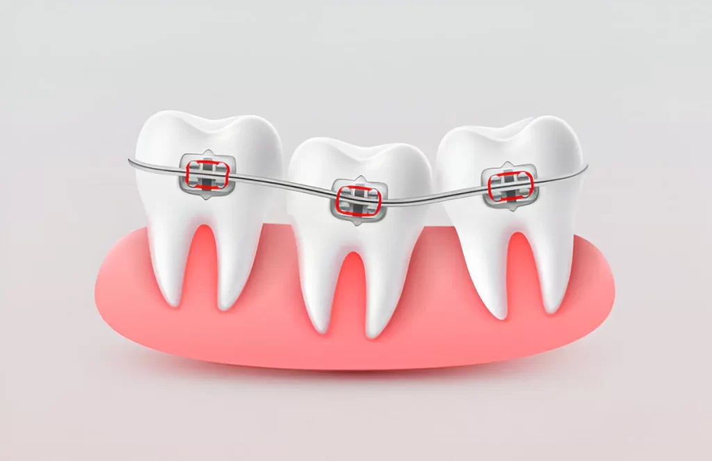Why Do So Many Filipinos Wear Braces on Their Teeth