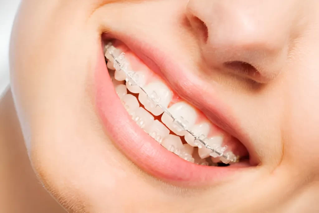 Why Do So Many Filipinos Wear Braces on Their Teeth