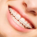 Why Do So Many Filipinos Wear Braces on Their Teeth? Real Truth Explained