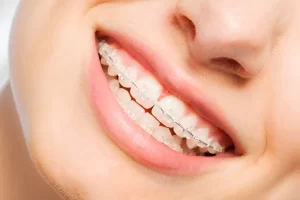 Why Do So Many Filipinos Wear Braces on Their Teeth? Real Truth Explained